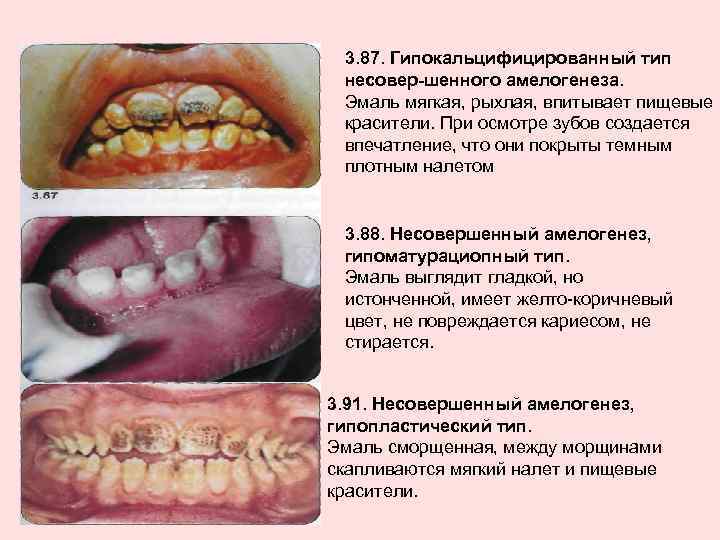 3. 87. Гипокальцифицированный тип несовер шенного амелогенеза. Эмаль мягкая, рыхлая, впитывает пищевые красители. При