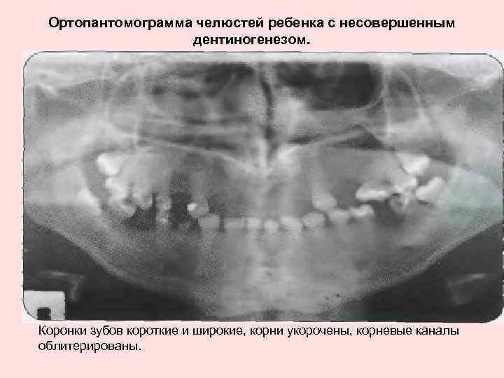 Ортопантомограмма челюстей ребенка с несовершенным дентиногенезом. Коронки зубов короткие и широкие, корни укорочены, корневые