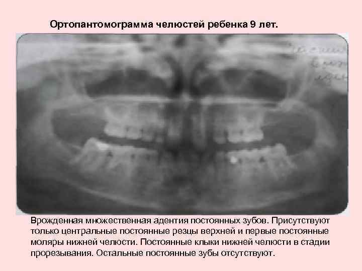 Ортопантомограмма челюстей ребенка 9 лет. Врожденная множественная адентия постоянных зубов. Присутствуют только центральные постоянные