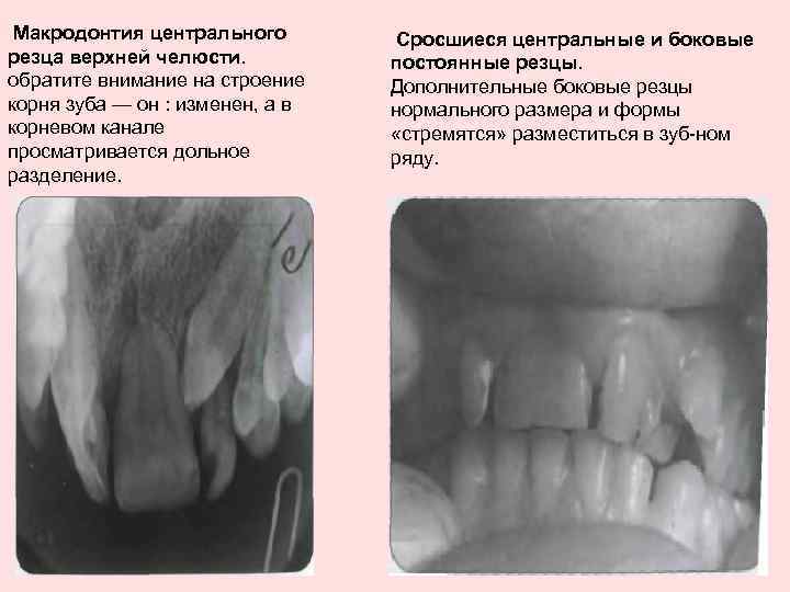 Макродонтия центрального резца верхней челюсти. обратите внимание на строение корня зуба — он :