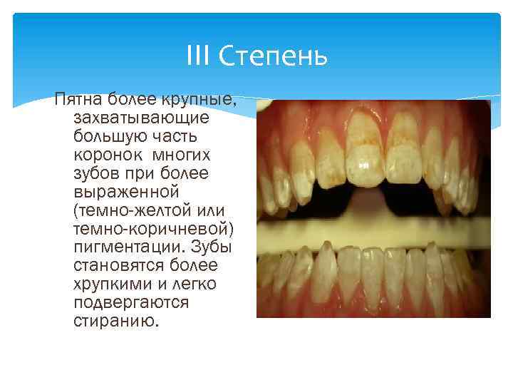 III Степень Пятна более крупные, захватывающие большую часть коронок многих зубов при более выраженной