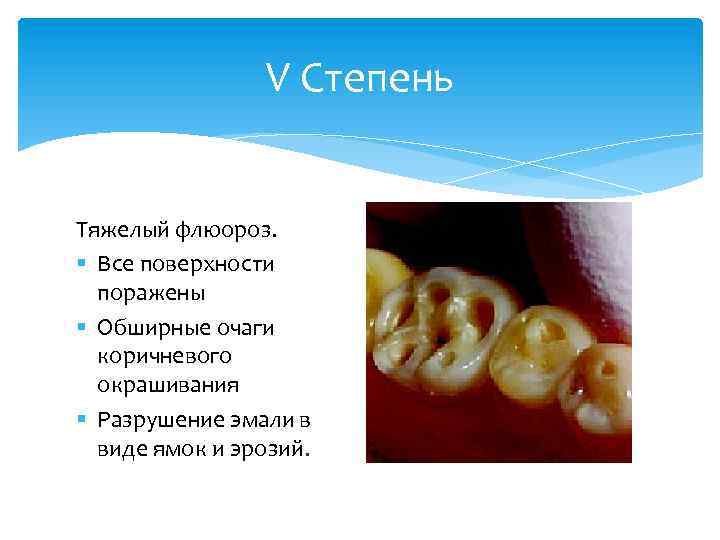 V Степень Тяжелый флюороз. § Все поверхности поражены § Обширные очаги коричневого окрашивания §