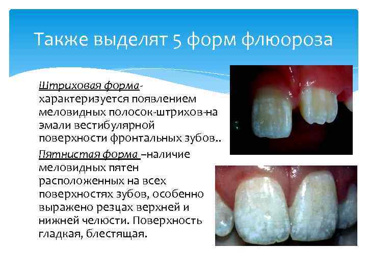 Также выделят 5 форм флюороза Штриховая формахарактеризуется появлением меловидных полосок-штрихов-на эмали вестибулярной поверхности фронтальных