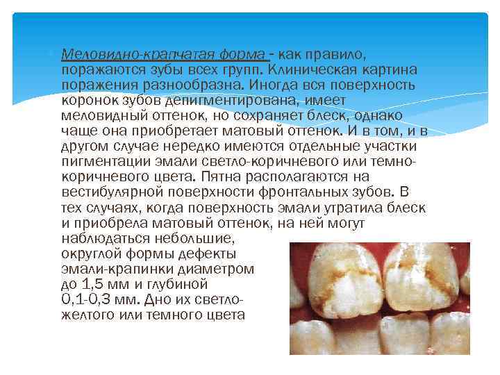  Меловидно-крапчатая форма - как правило, поражаются зубы всех групп. Клиническая картина поражения разнообразна.