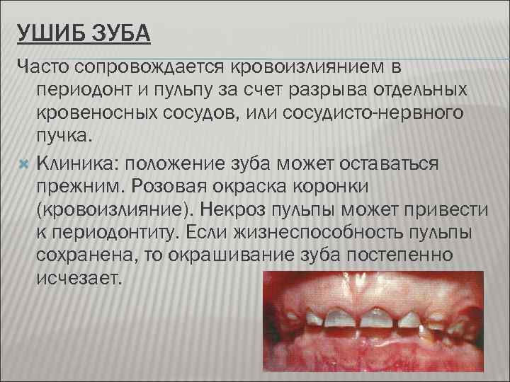 УШИБ ЗУБА Часто сопровождается кровоизлиянием в периодонт и пульпу за счет разрыва отдельных кровеносных