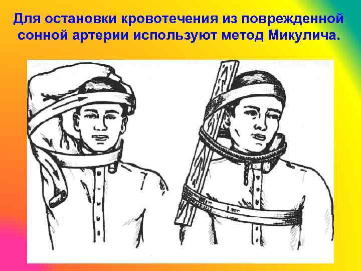 Для остановки кровотечения из поврежденной сонной артерии используют метод Микулича. 
