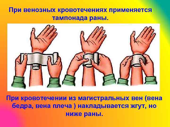 При венозных кровотечениях применяется тампонада раны. При кровотечении из магистральных вен (вена бедра, вена