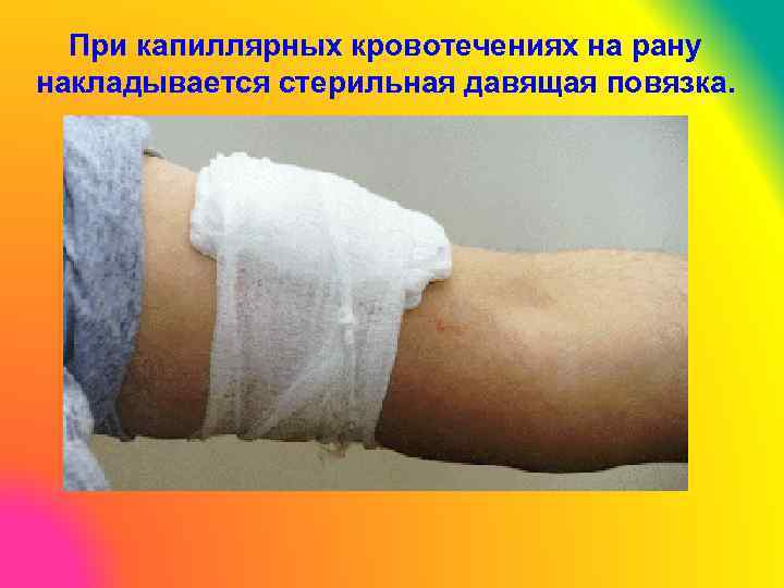 При капиллярных кровотечениях на рану накладывается стерильная давящая повязка. 