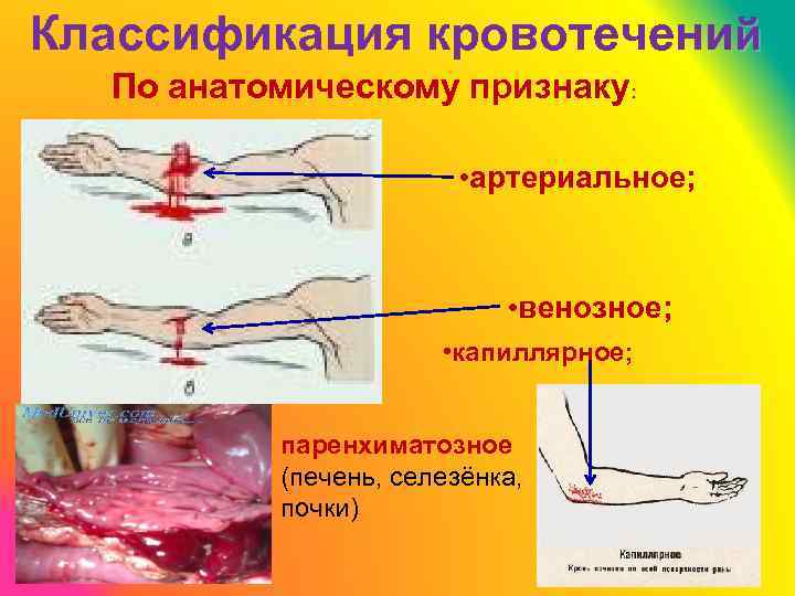 Классификация кровотечений По анатомическому признаку: • артериальное; • венозное; • капиллярное; паренхиматозное (печень, селезёнка,