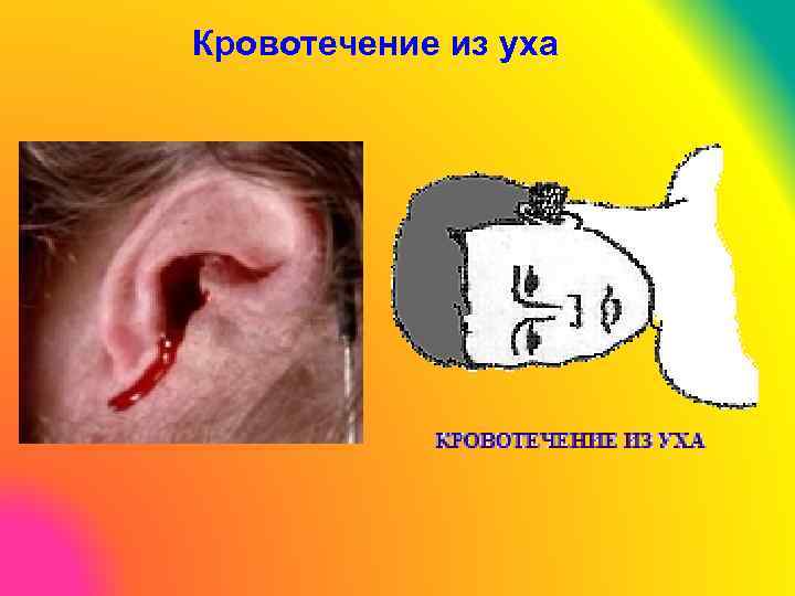 Кровотечение из уха 