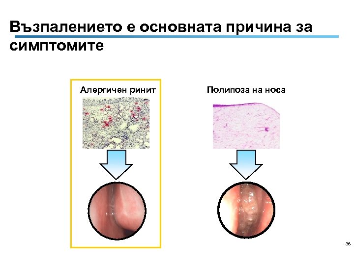 Възпалението е основната причина за симптомите Алергичен ринит Полипоза на носа 36 