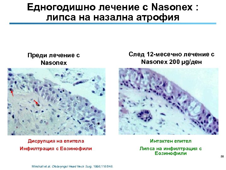 Едногодишно лечение с Nasonex : липса на назална атрофия Преди лечение с Nasonex След
