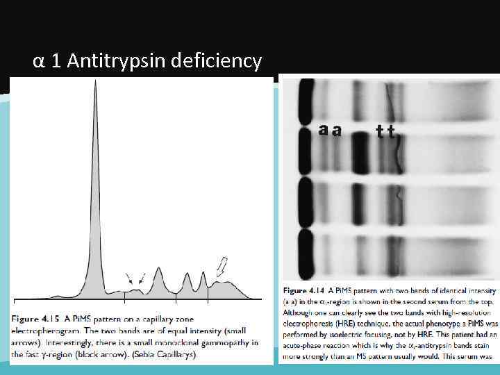 α 1 Antitrypsin deficiency 