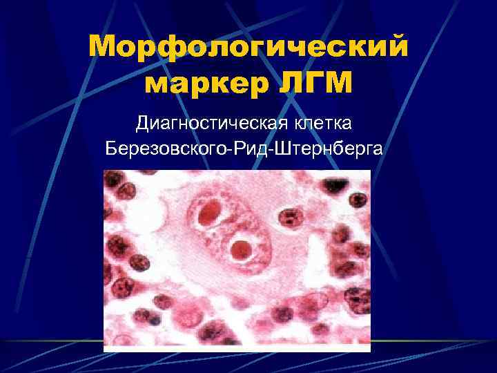 Морфологический маркер ЛГМ Диагностическая клетка Березовского-Рид-Штернберга 