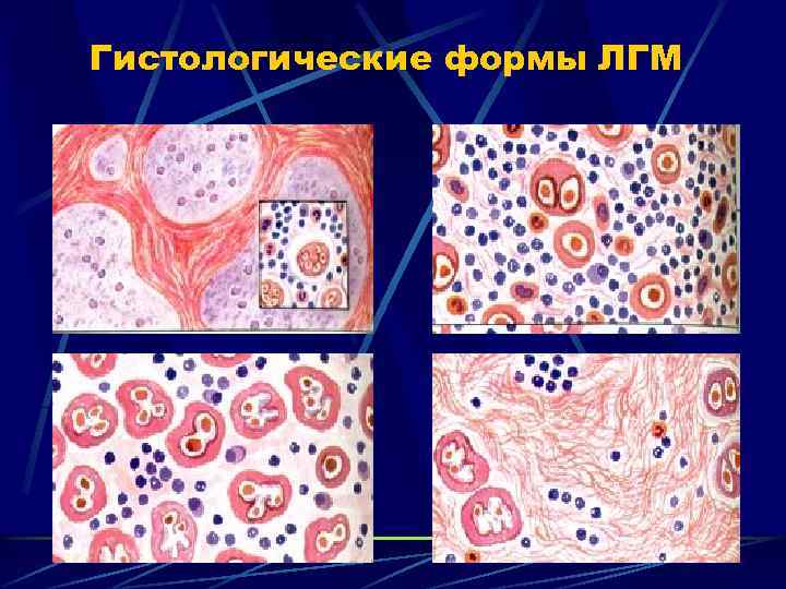 Гистологические формы ЛГМ 