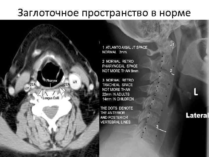 Заглоточный абсцесс