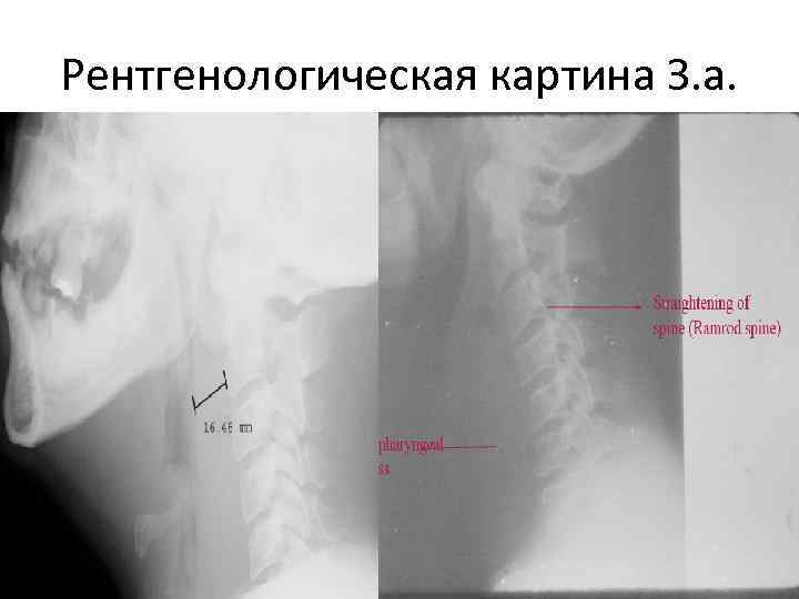 Паратанзиальная абсцесс карта вызова