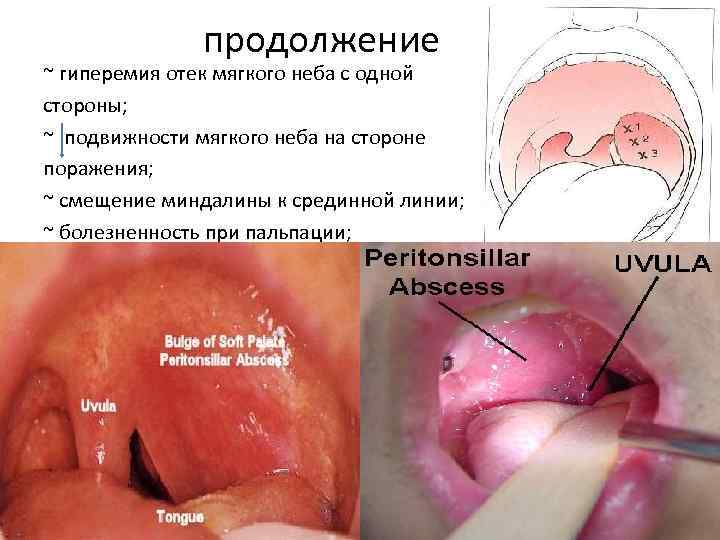 продолжение ~ гиперемия отек мягкого неба с одной стороны; ~ подвижности мягкого неба на