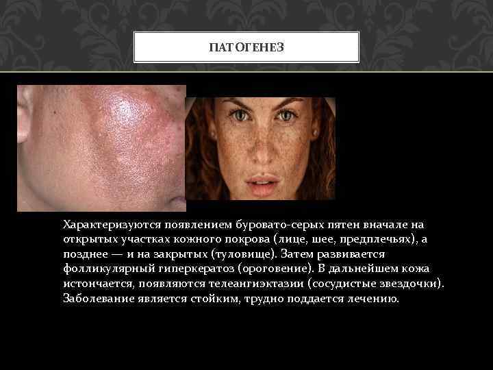 ПАТОГЕНЕЗ Характеризуются появлением буровато-серых пятен вначале на открытых участках кожного покрова (лице, шее, предплечьях),