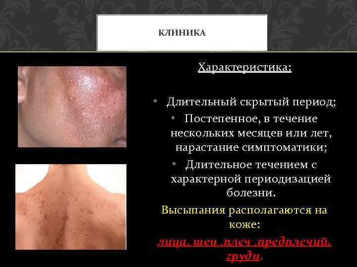 КЛИНИКА Характеристика: • Длительный скрытый период; • Постепенное, в течение нескольких месяцев или лет,