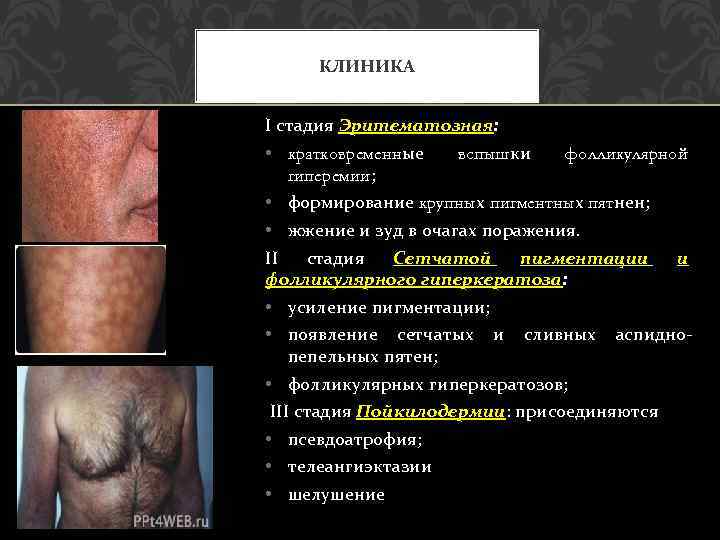 КЛИНИКА I стадия Эритематозная: • кратковременные вспышки фолликулярной гиперемии; • формирование крупных пигментных пятнен;