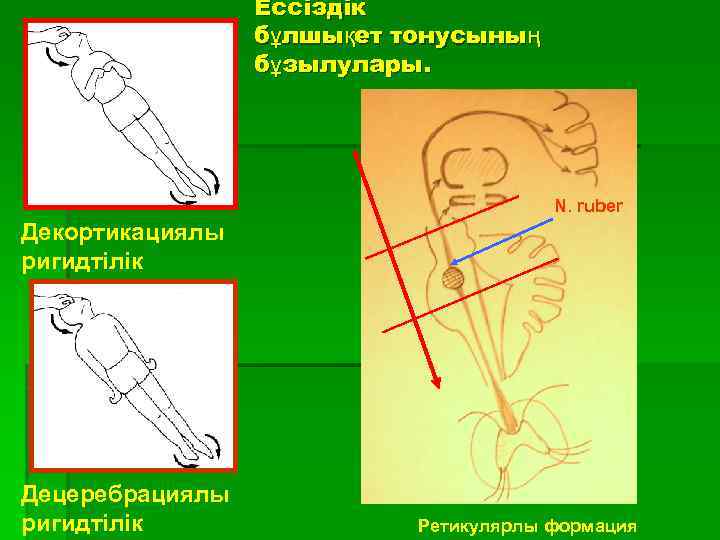 Ессіздік бұлшықет тонусының бұзылулары. N. ruber Декортикациялы ригидтілік Децеребрациялы ригидтілік Ретикулярлы формация 