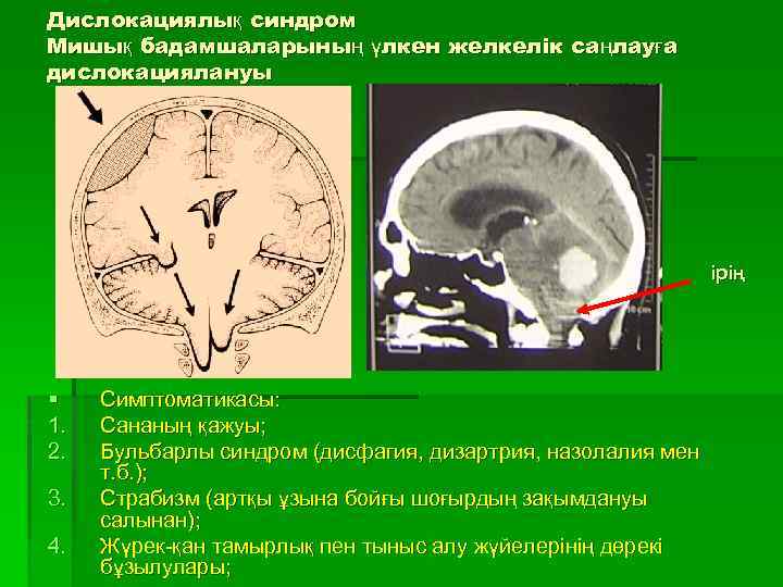 Синдромы мозжечка