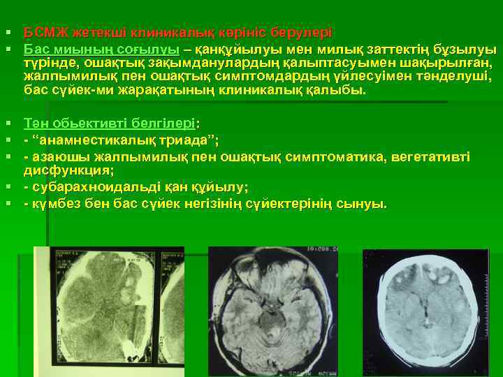 § БСМЖ жетекші клиникалық көрініс берулері § Бас миының соғылуы – қанқұйылуы мен милық