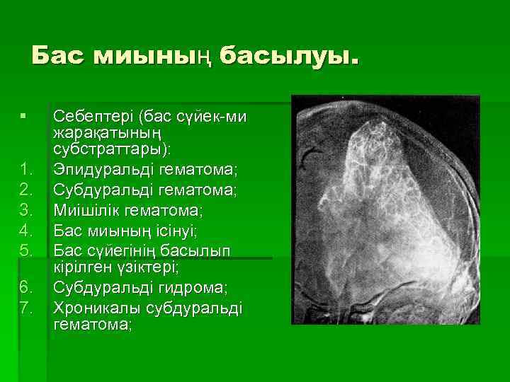 Бас миының басылуы. § 1. 2. 3. 4. 5. 6. 7. Себептері (бас сүйек-ми