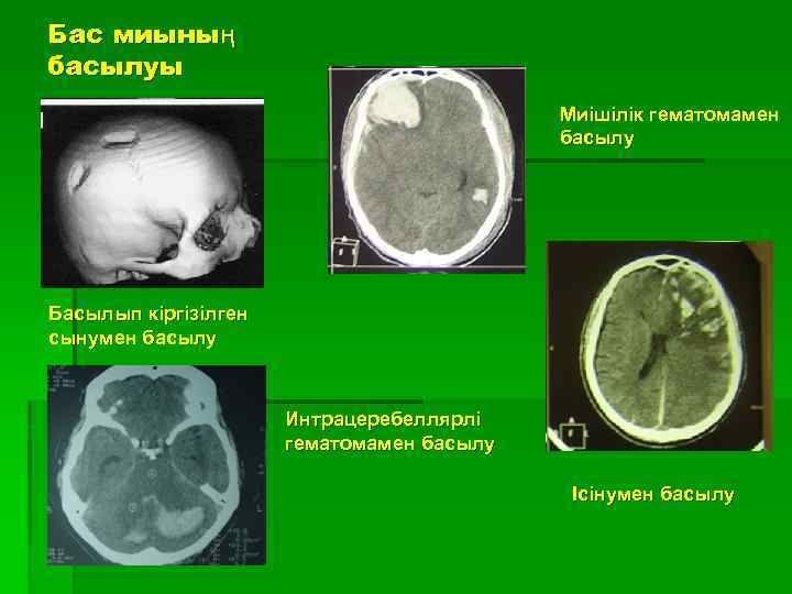 Бас миының басылуы Миішілік гематомамен басылу Басылып кіргізілген сынумен басылу Интрацеребеллярлі гематомамен басылу Ісінумен