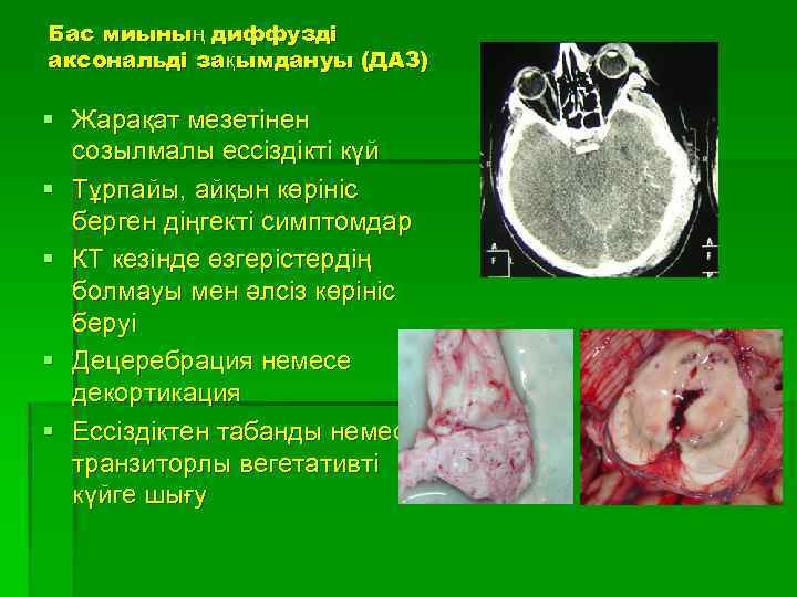 Бас миының диффузді аксональді зақымдануы (ДАЗ) § Жарақат мезетінен созылмалы ессіздікті күй § Тұрпайы,
