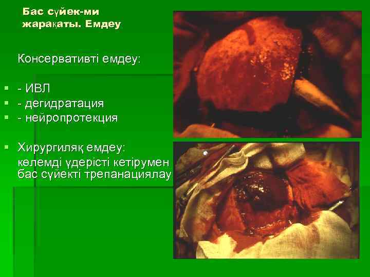 Бас сүйек-ми жарақаты. Емдеу Консервативті емдеу: § § § - ИВЛ - дегидратация -