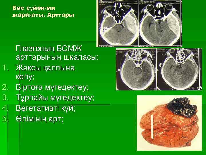 Бас сүйек-ми жарақаты. Арттары 1. 2. 3. 4. 5. Глазгоның БСМЖ арттарының шкаласы: Жақсы