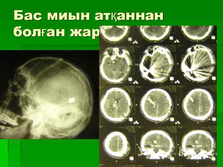 Бас миын атқаннан болған жаралары 