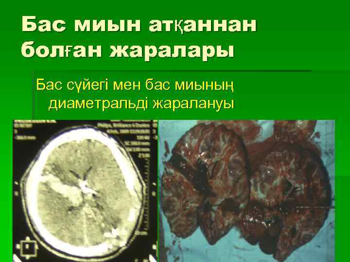 Бас миын атқаннан болған жаралары Бас сүйегі мен бас миының диаметральді жаралануы 
