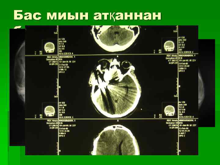 Бас миын атқаннан болған жаралары 