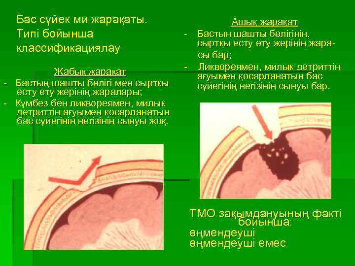 Бас сүйек ми жарақаты. Типі бойынша классификациялау Жабық жарақат - Бастың шашты бөлігі мен