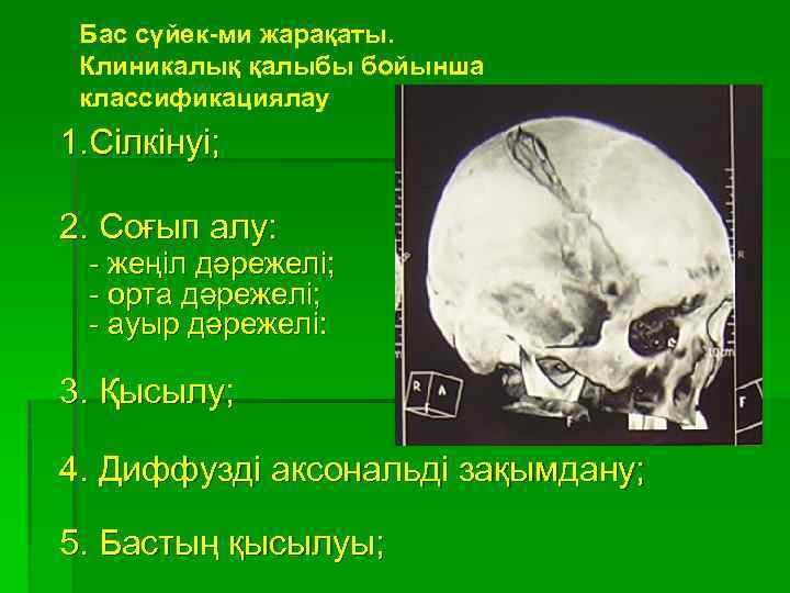 Бас сүйек-ми жарақаты. Клиникалық қалыбы бойынша классификациялау 1. Сілкінуі; 2. Соғып алу: - жеңіл