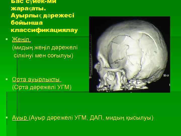 Бас сүйек-ми жарақаты. Ауырлық дәрежесі бойынша классификациялау § Жеңіл (мидың жеңіл дәрежелі сілкінуі мен