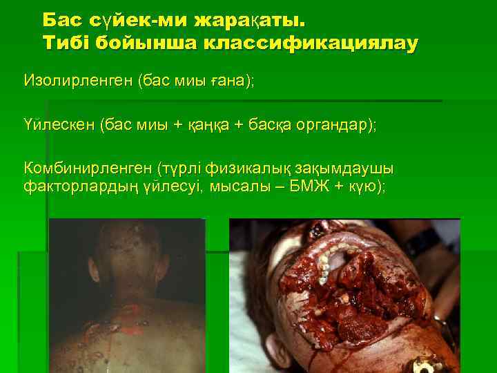 Бас сүйек-ми жарақаты. Тибі бойынша классификациялау Изолирленген (бас миы ғана); Үйлескен (бас миы +