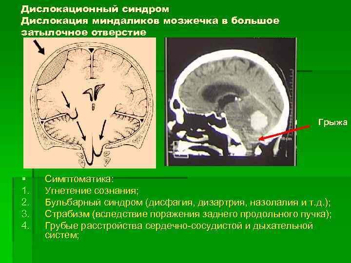 Дислокационный синдром Дислокация миндаликов мозжечка в большое затылочное отверстие Грыжа § 1. 2. 3.