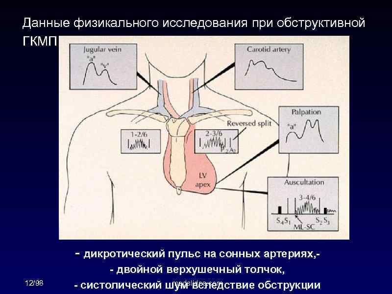 Данные физикального исследования при обструктивной ГКМП 12/98 - дикротический пульс на сонных артериях, -