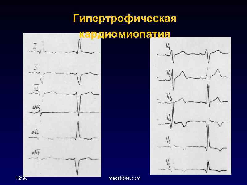 Гипертрофическая кардиомиопатия 12/98 medslides. com 