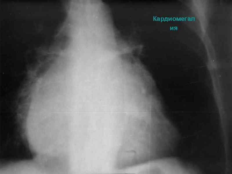 Кардиомегал ия 12/98 medslides. com 