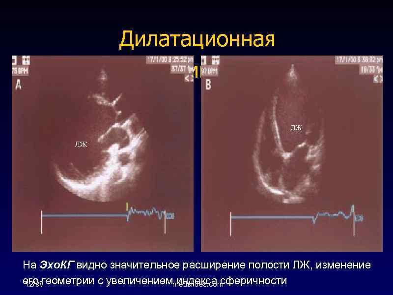 Дилатационная кардиомиопатия ЛЖ ЛЖ На Эхо. КГ видно значительное расширение полости ЛЖ, изменение его