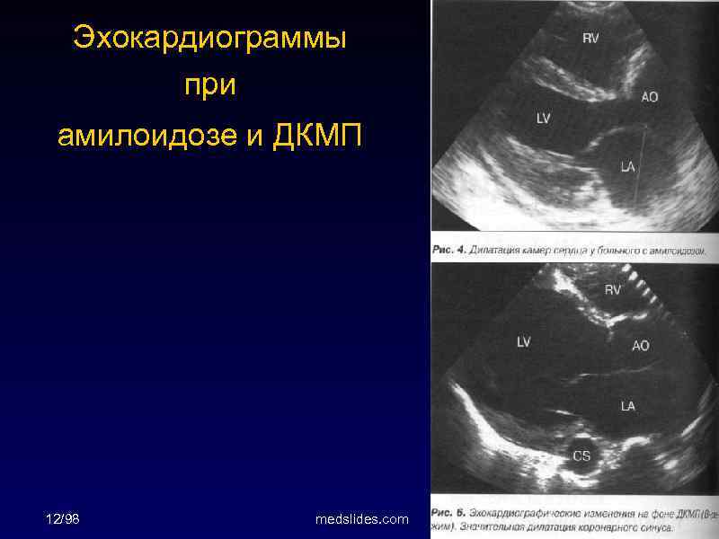 Эхокардиограммы при амилоидозе и ДКМП 12/98 medslides. com 