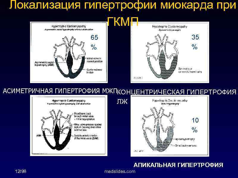 Локализация гипертрофии миокарда при ГКМП 35 % 65 % АСИМЕТРИЧНАЯ ГИПЕРТРОФИЯ МЖПКОНЦЕНТРИЧЕСКАЯ ГИПЕРТРОФИЯ ЛЖ