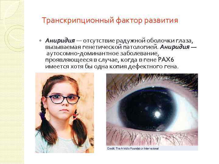 Транскрипционный фактор развития Аниридия — отсутствие радужной оболочки глаза, вызываемая генетической патологией. Аниридия —