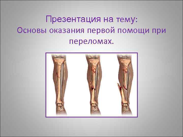 Презентация на тему: Основы оказания первой помощи при переломах. 