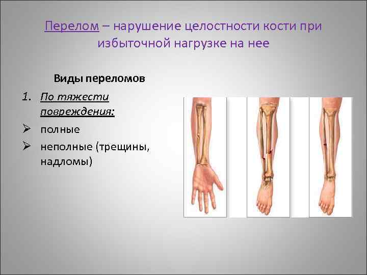 Перелом – нарушение целостности кости при избыточной нагрузке на нее Виды переломов 1. По